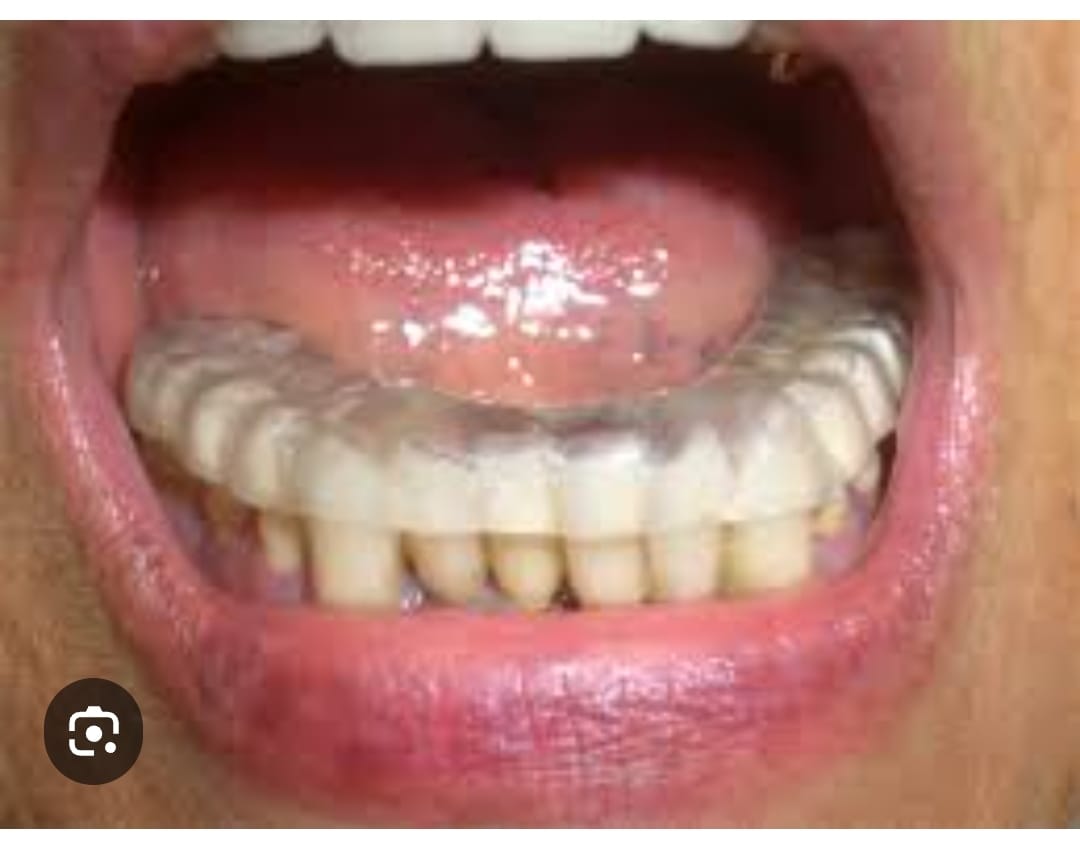 Dispositivo Bite dentale