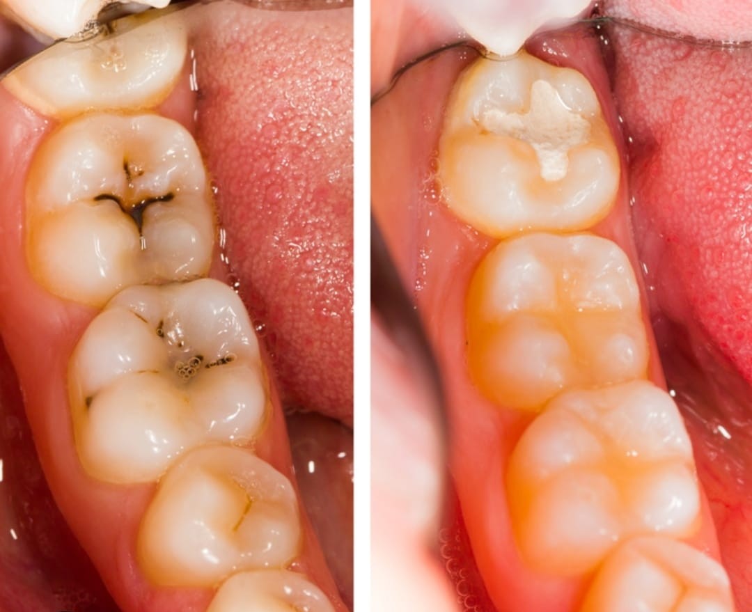 Conservativa ed Endodonzia