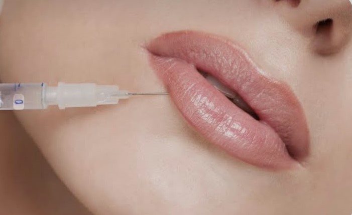 Filler Acido Ialuronico Periorale